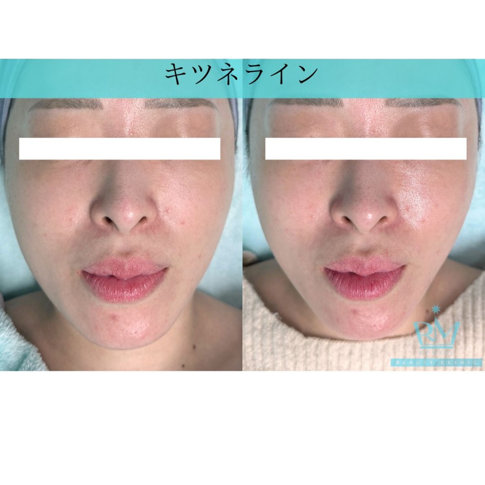 小顔