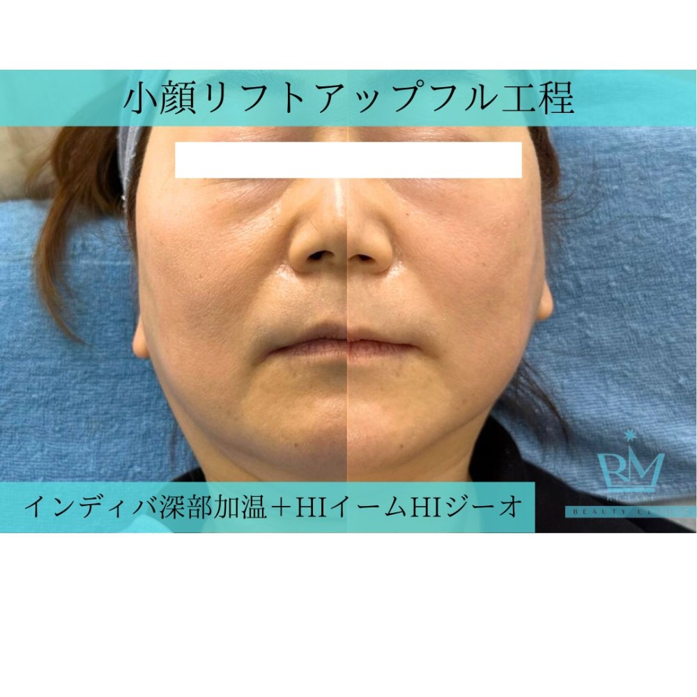 小顔