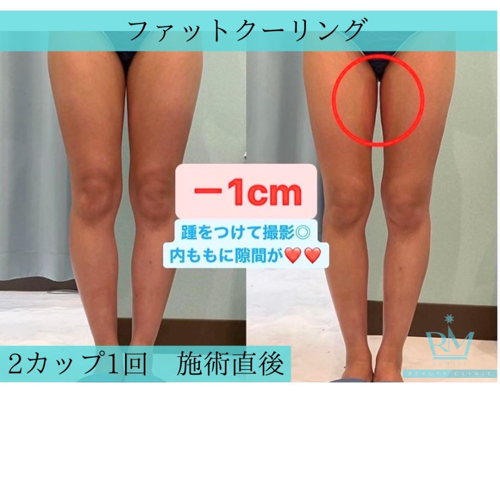 痩身