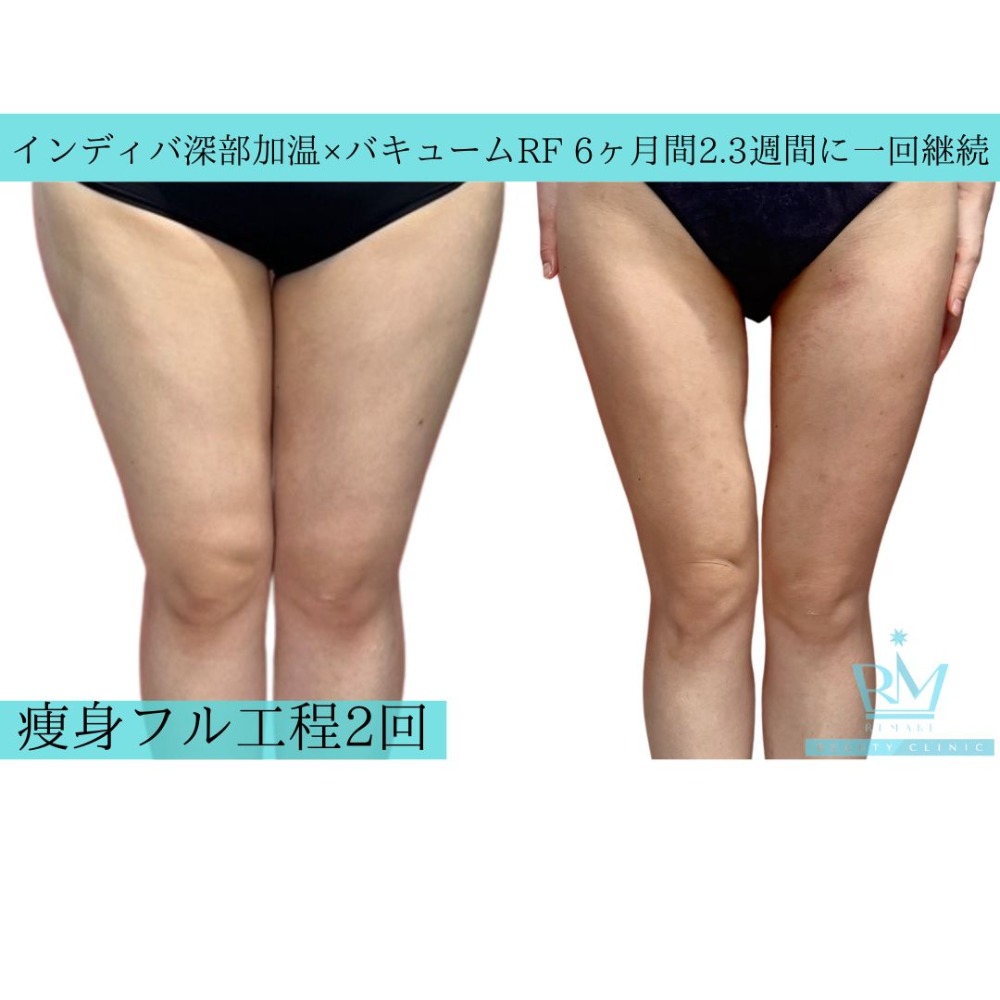 痩身