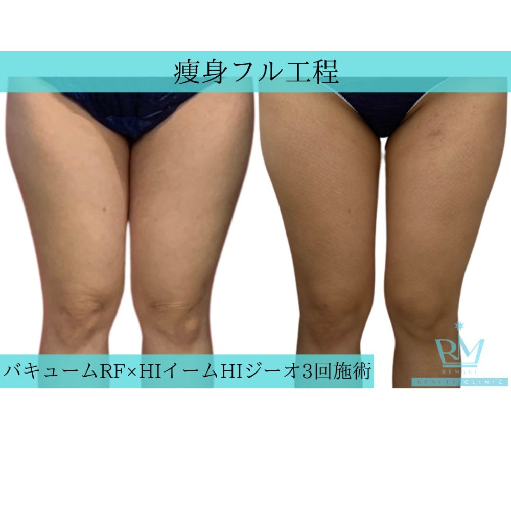 痩身