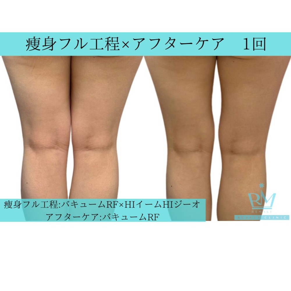 痩身