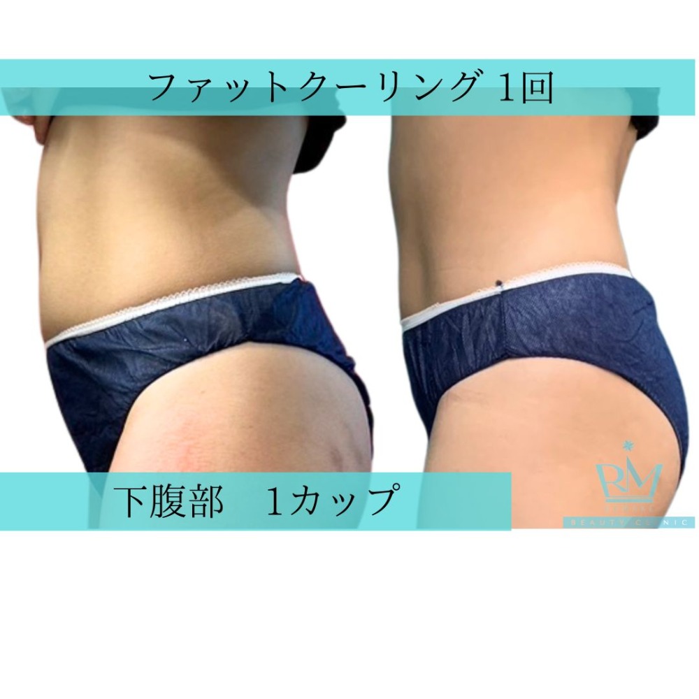 痩身
