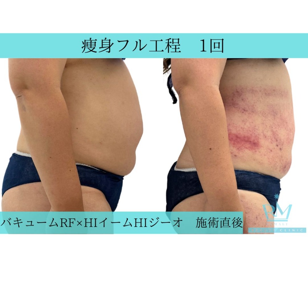 痩身