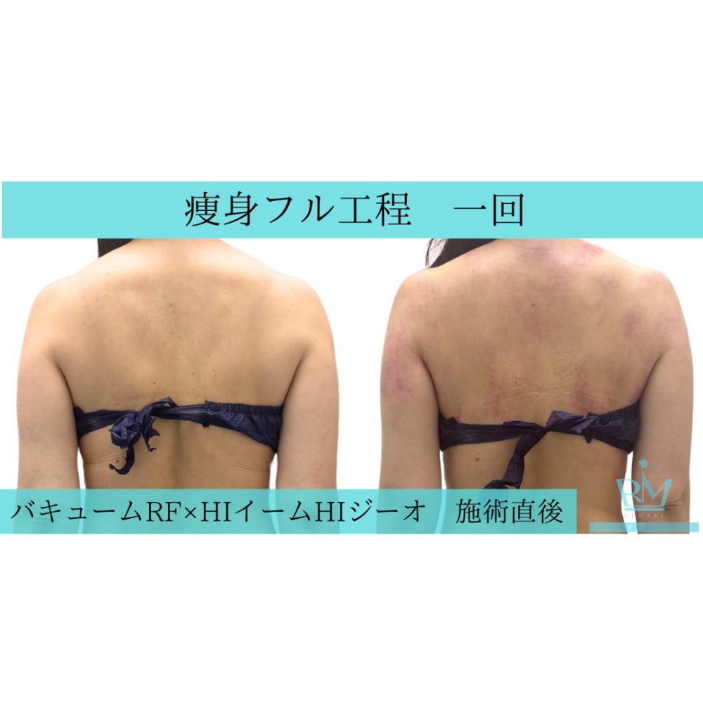 痩身