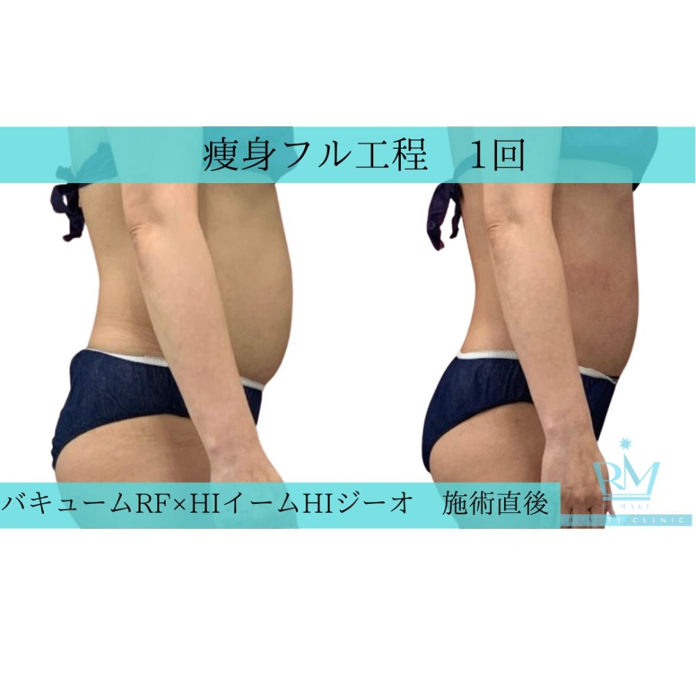 痩身